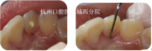 腭侧探诊 2mm, 深牙周袋消失
